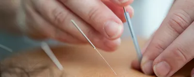 Acupuncture