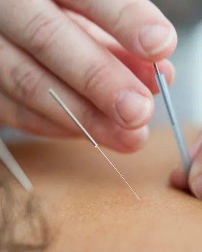 Acupuncture