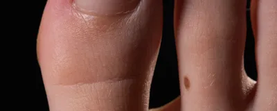 Nail care
