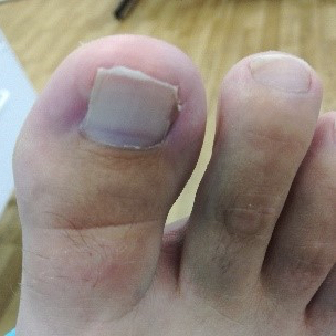 Ingrowing Toenail Cure